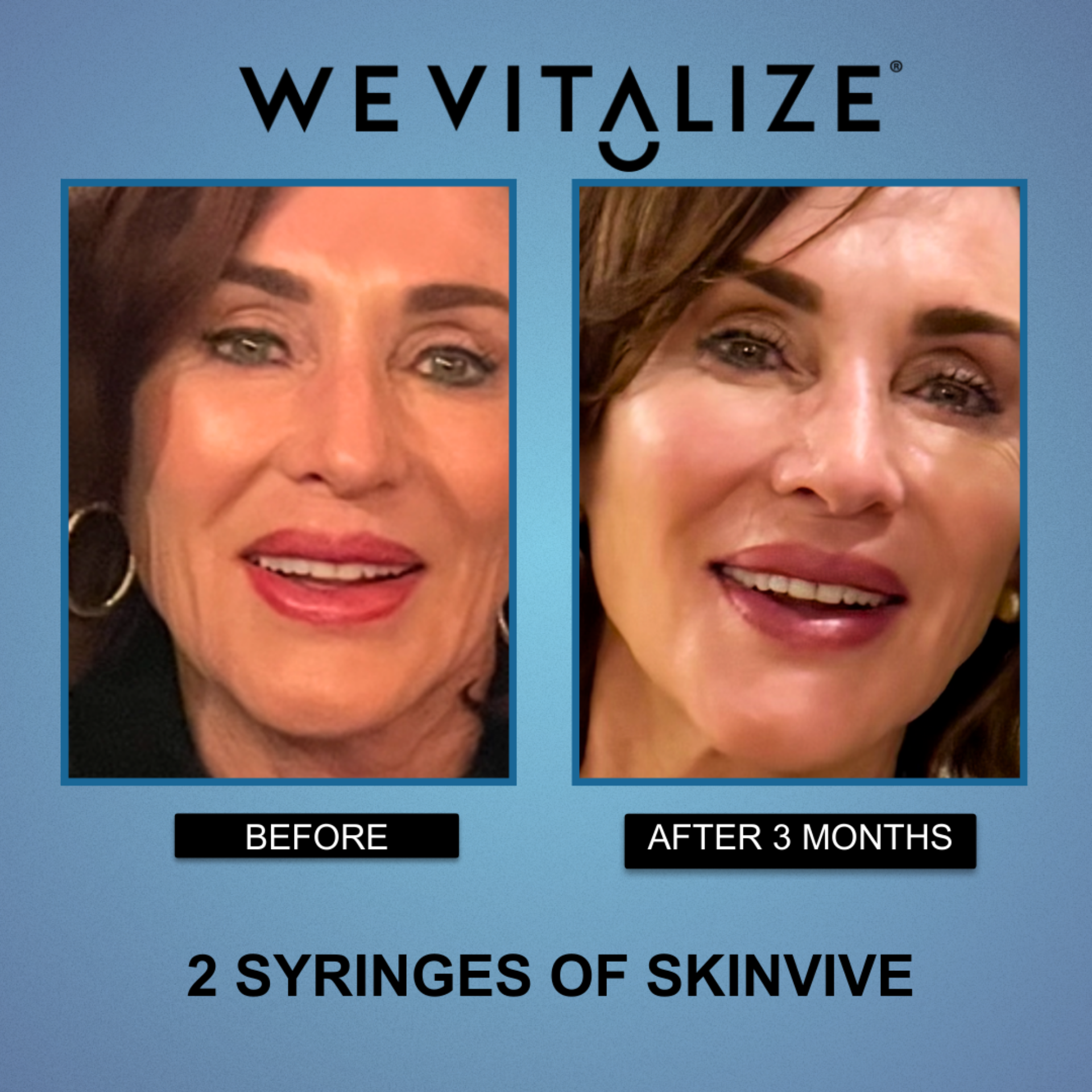 Aesthetic Injectables at WeVitalize in  Huntington Beach, CA